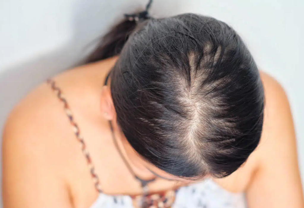 Understanding Hereditary Hair Loss in Women & Natural Herbal Solutions
