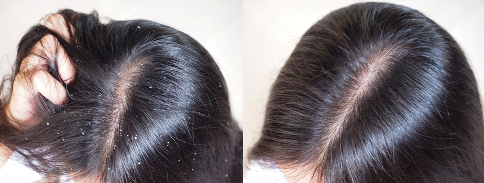 Natural Remedies for Dandruff: How to Treat Flaky Scalp Naturally